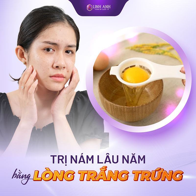 cách trị nám da lâu năm cách trị nám tàn nhang lâu năm bằng lòng trắng trứng