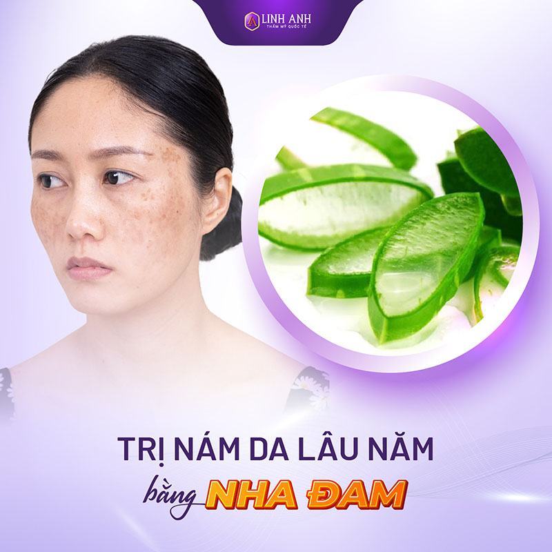 cách trị nám tàn nhang lâu năm bằng nha đam