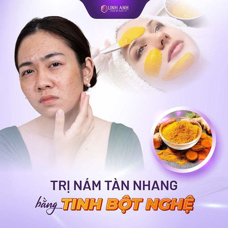 cách trị nám tàn nhang lâu năm cách trị nám tàn nhang lâu năm bằng tinh bột nghệ