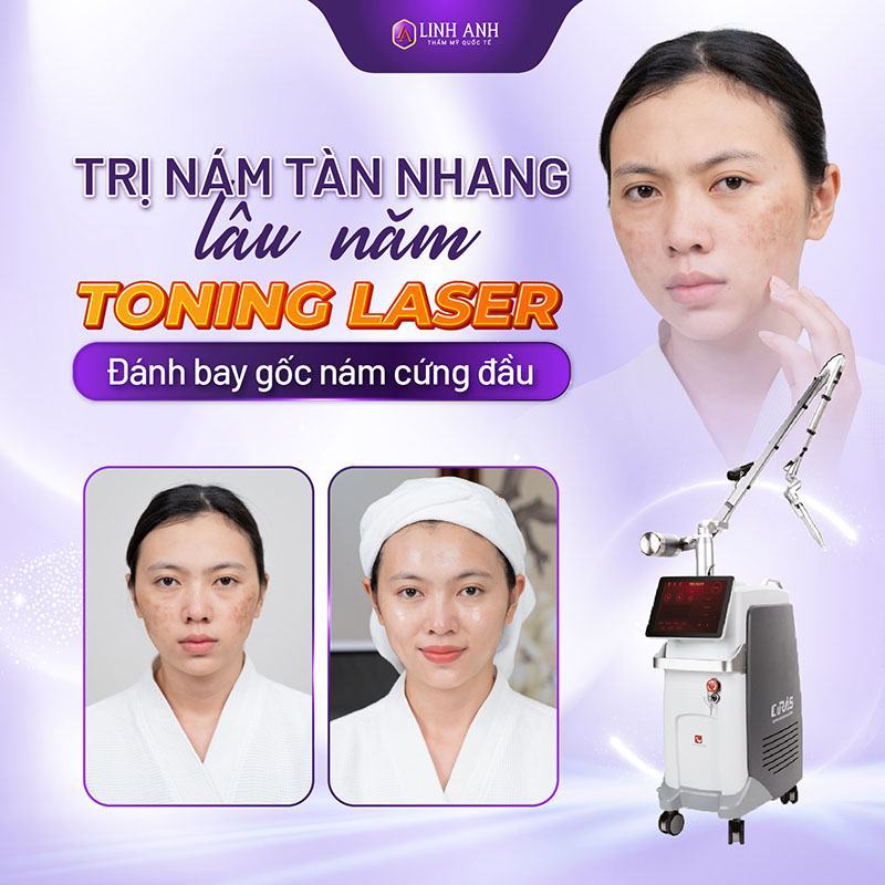 cách trị nám