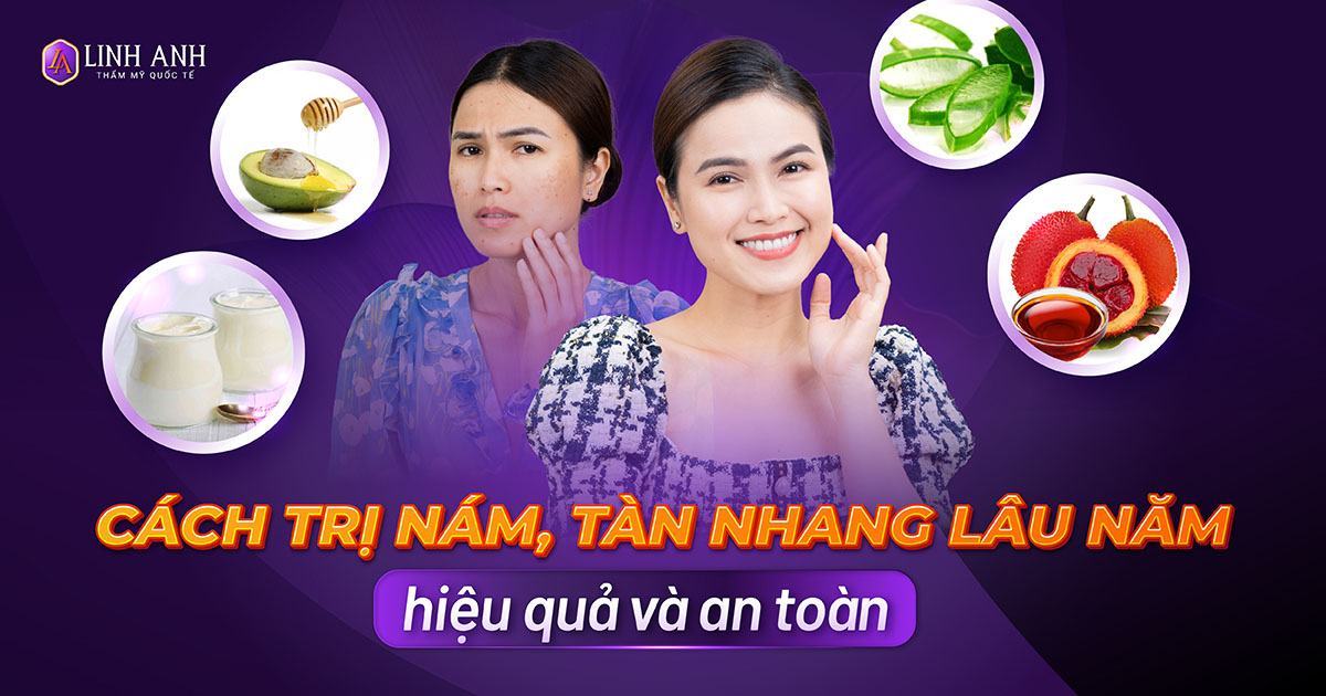 12 cách trị nám da mặt lâu năm hiệu quả, an toàn ít ai biết