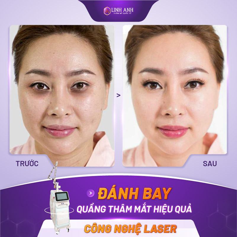 cách trị quầng thâm ở mắt