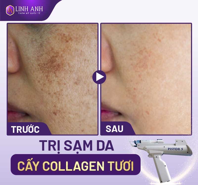 chữa sạm da cách trị sạm da mặt đơn giản