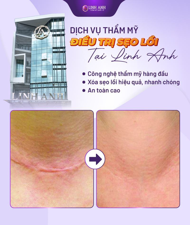 cách trị sẹo lồi trên mặt cách trị sẹo lồi trên mặt
