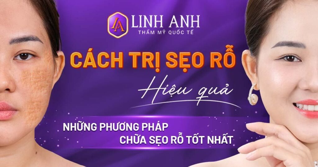cách trị sẹo rỗ