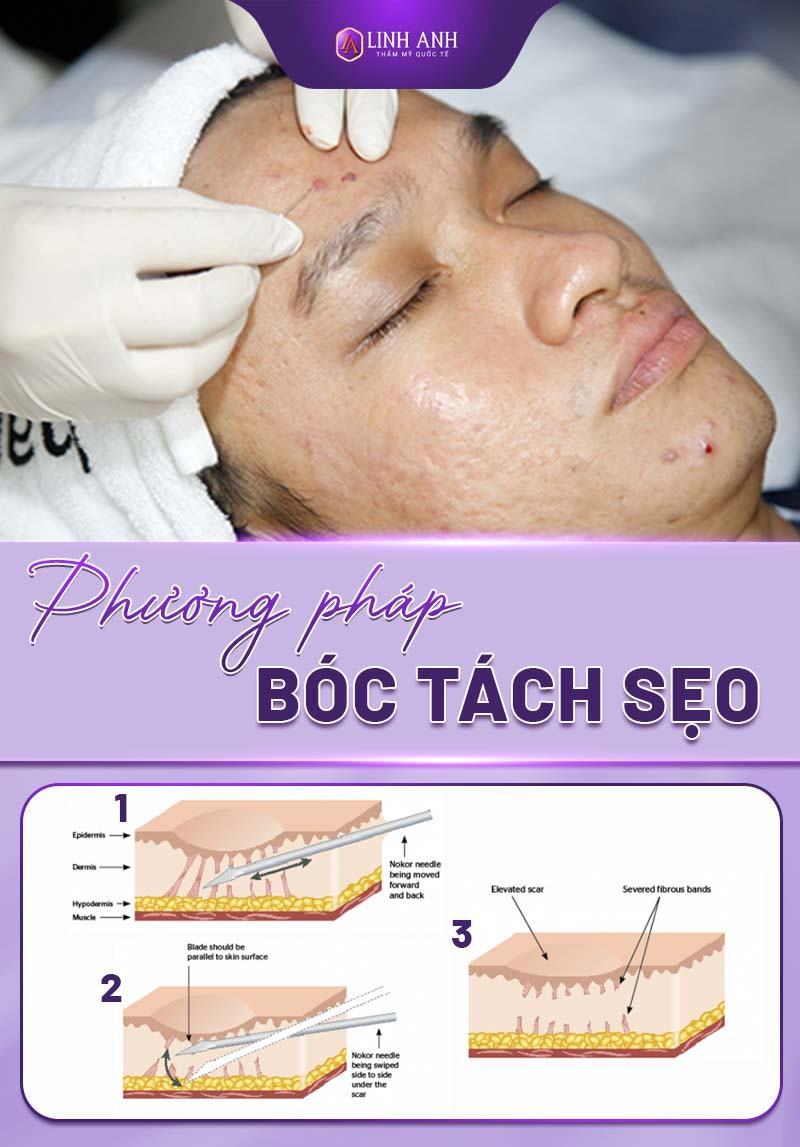 cách trị sẹo rỗ cách trị sẹo rỗ bằng phương pháp tự nhiên