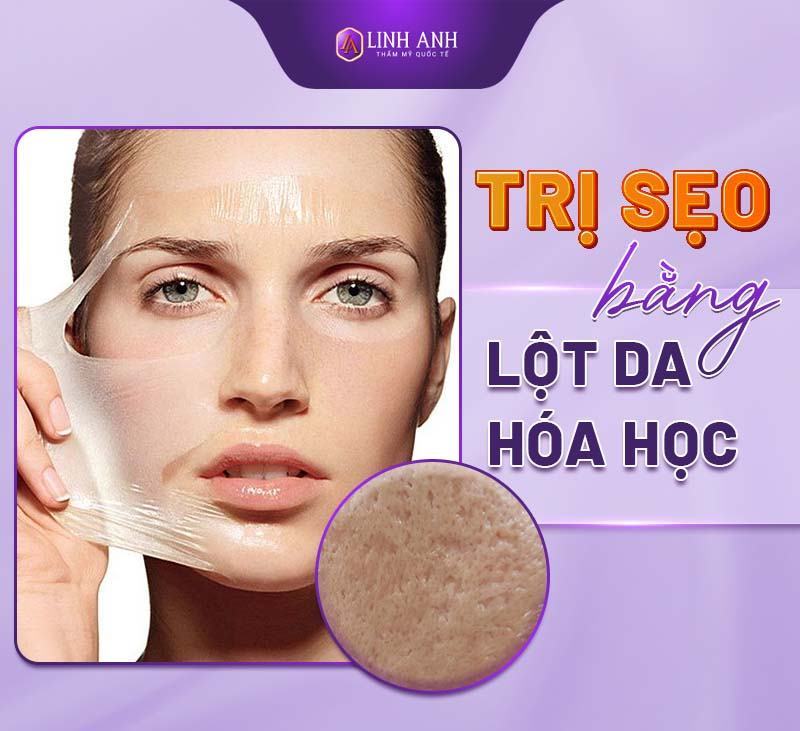 cách trị sẹo rỗ trên mặt cách trị sẹo rỗ dân gian