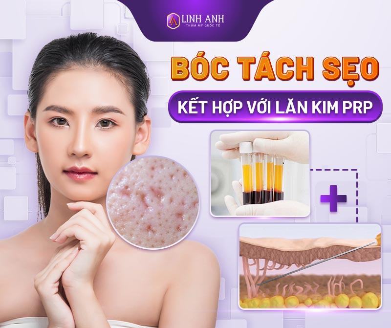 kinh nghiệm trị sẹo rỗ lâu năm - Thẩm mỹ Quốc tế Linh Anh cách trị sẹo rỗ lâu năm hiệu quả nhất