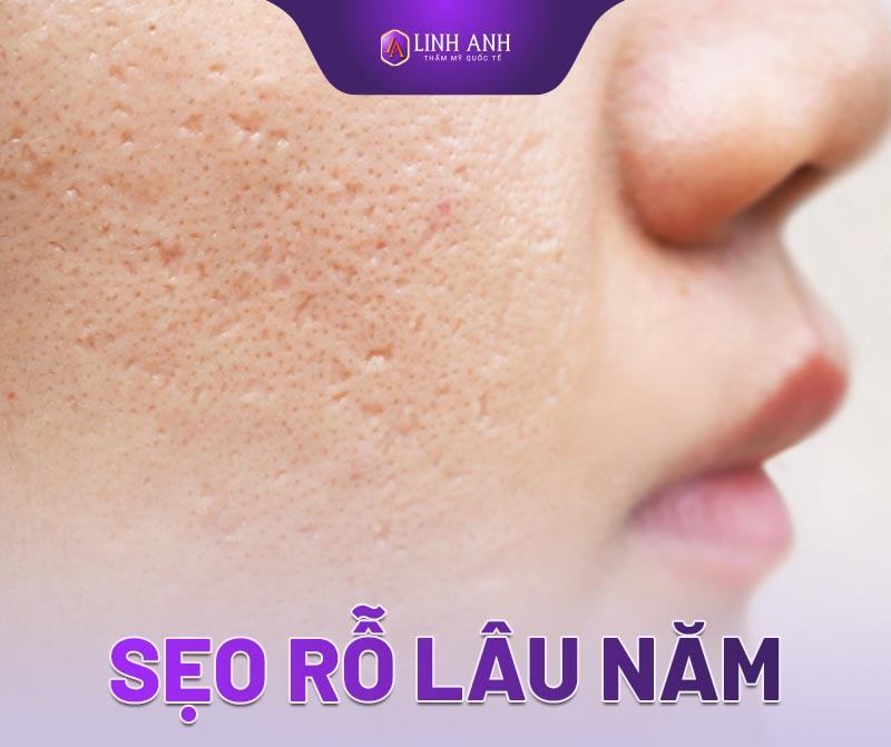 cách trị sẹo rỗ lâu năm