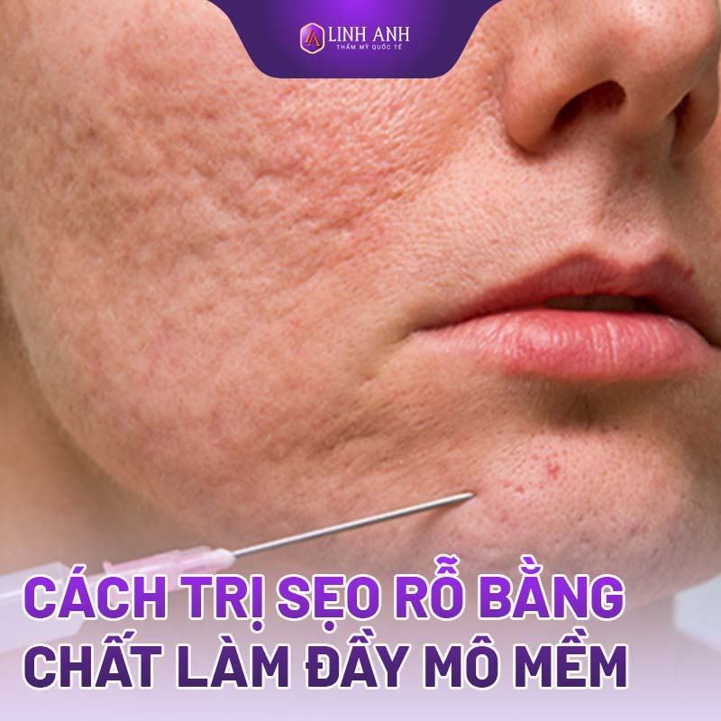 cách điều trị sẹo rỗ cách trị sẹo rỗ lỗ chân lông to
