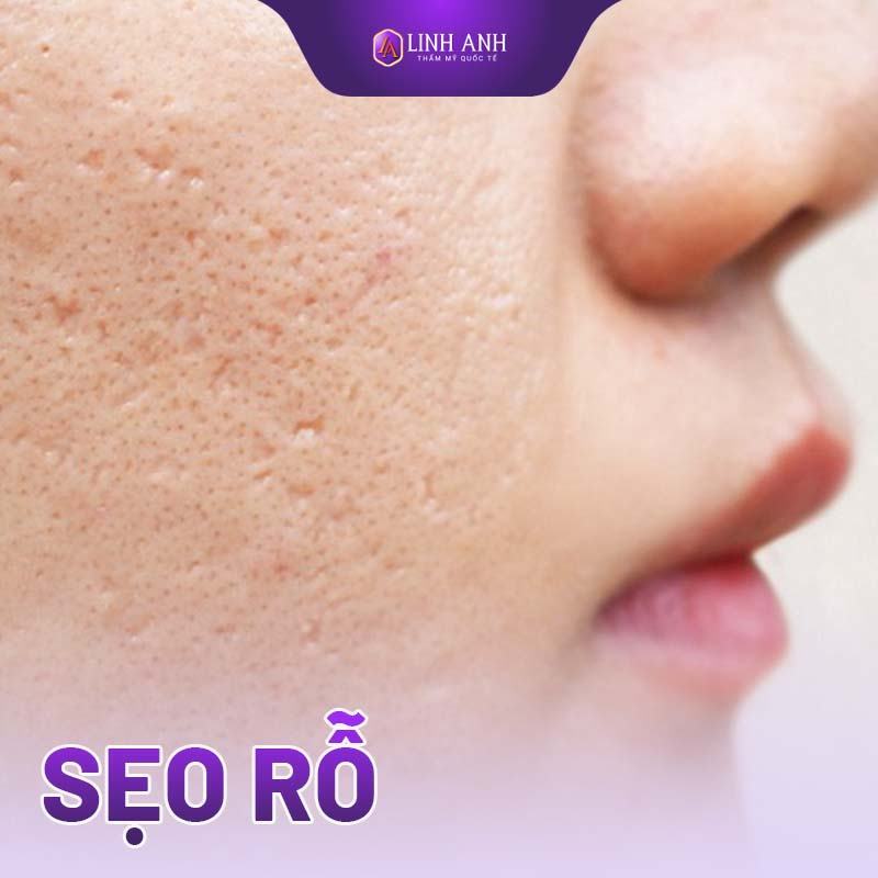 cách trị sẹo rỗ cách trị sẹo rỗ tại nhà