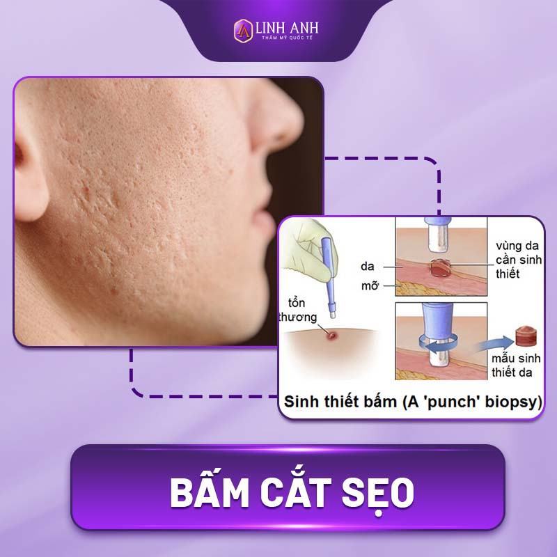 cách trị sẹo rỗ lỗ chân lông to cách trị sẹo rổ trên mặt tại nhà