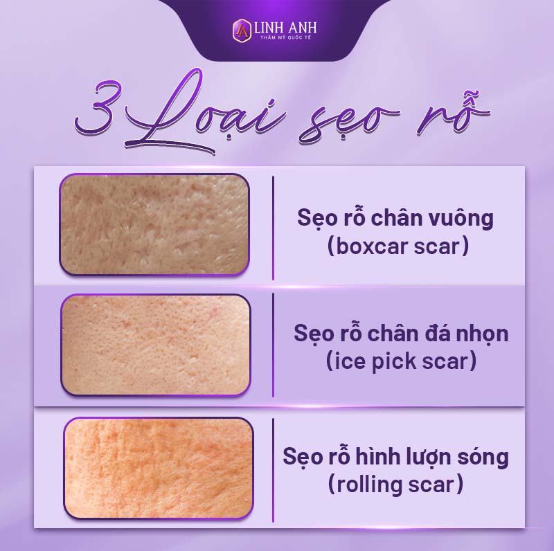 cách trị sẹo rỗ tại nhà cách trị sẹo rỗ trên mặt