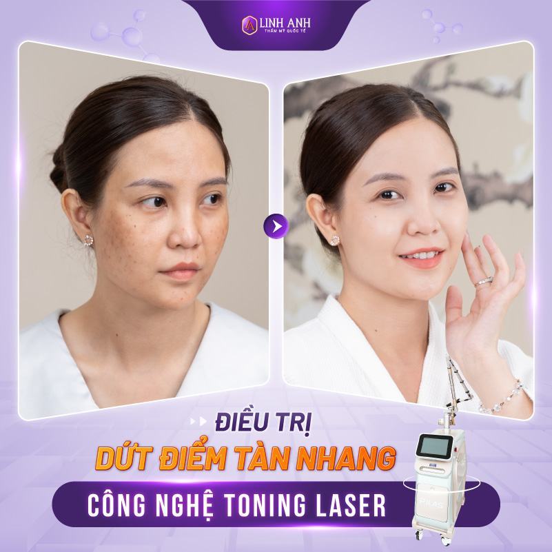 tàn nhang bẩm sinh có chữa được không cách trị tàn nhang bẩm sinh an toàn