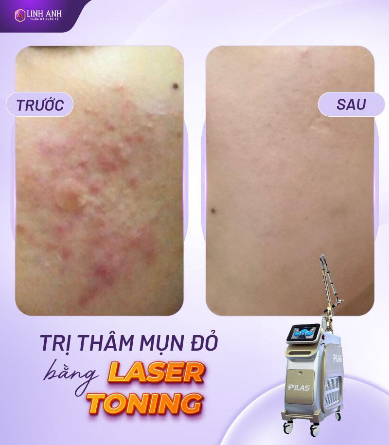 trị thâm mụn đỏ cách trị thâm đỏ sau khi nặn mụn