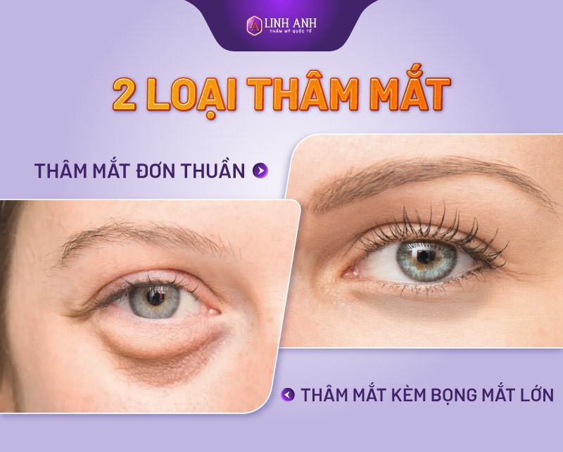 cách trị quầng thâm mắt cách trị thâm mắt