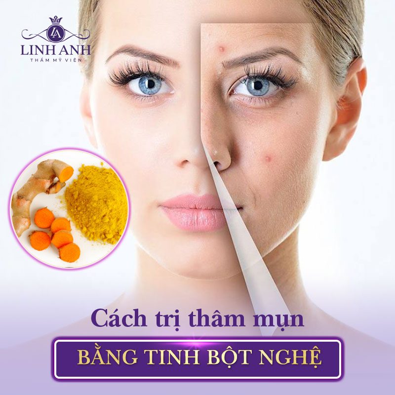 cách trị thâm mụn tại nhà bằng nghệ