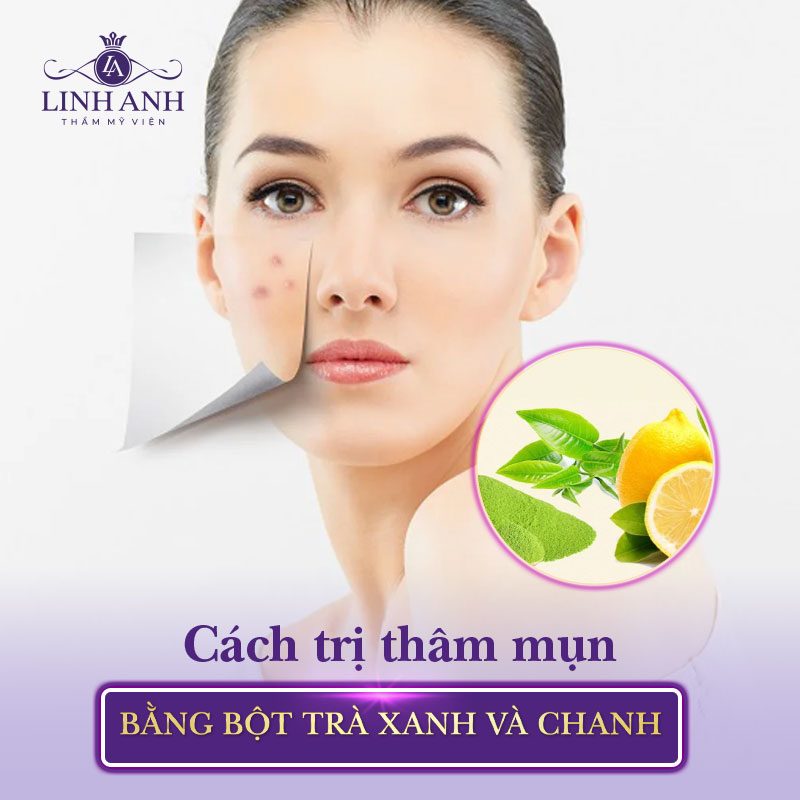 cách trị thâm mụn tại nhà nhanh nhất