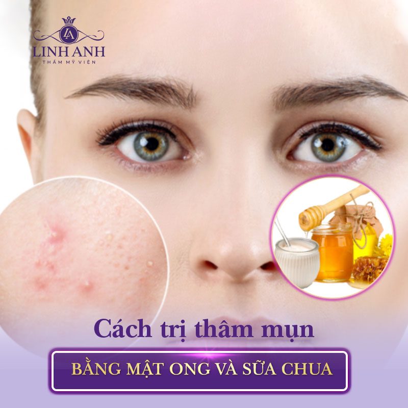 cách trị thâm mụn