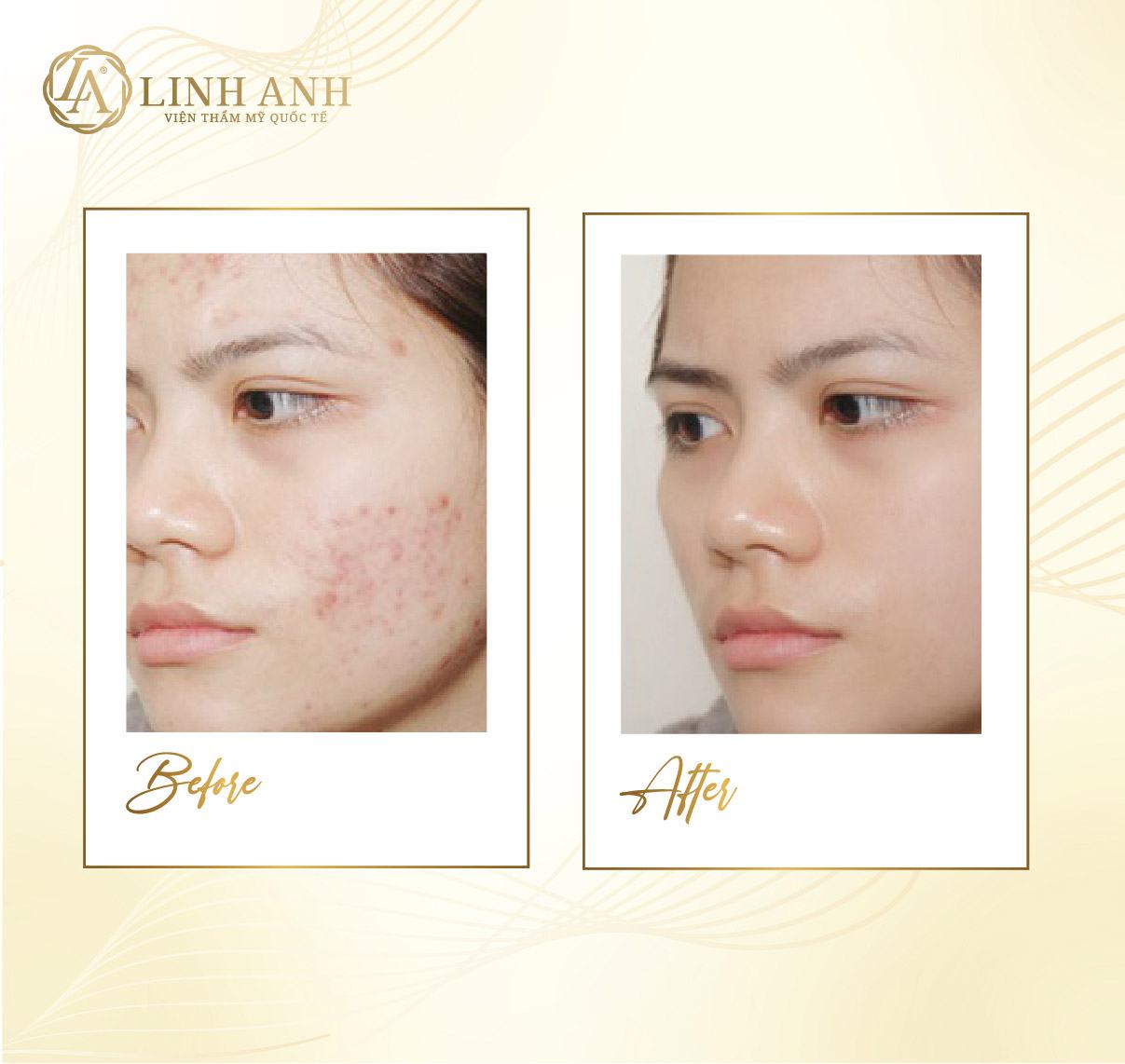 da mụn có nên cạo lông mặt hay không cạo lông mặt khi da bị mụn được không - Viện thẩm mỹ quốc tế Linh Anh