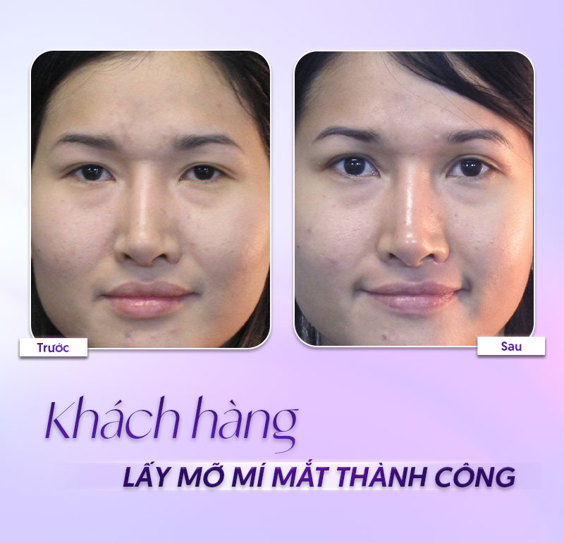 cắt mỡ mắt trên bao nhiêu cắt mỡ mắt trên bao nhiêu