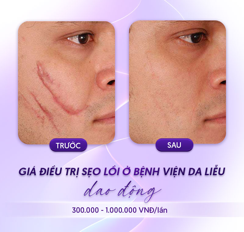 cắt sẹo lồi ở bệnh viện da liễu cắt sẹo lồi ở bệnh viện da liễu