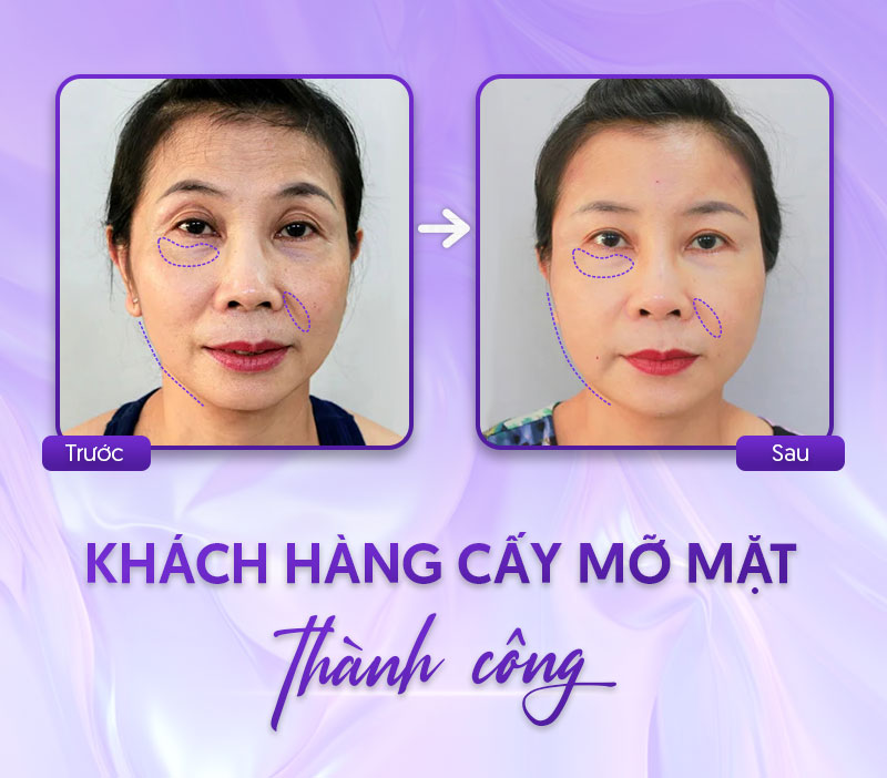 cấy mỡ mặt bao nhiêu tiền cấy mỡ mặt bao nhiêu tiền
