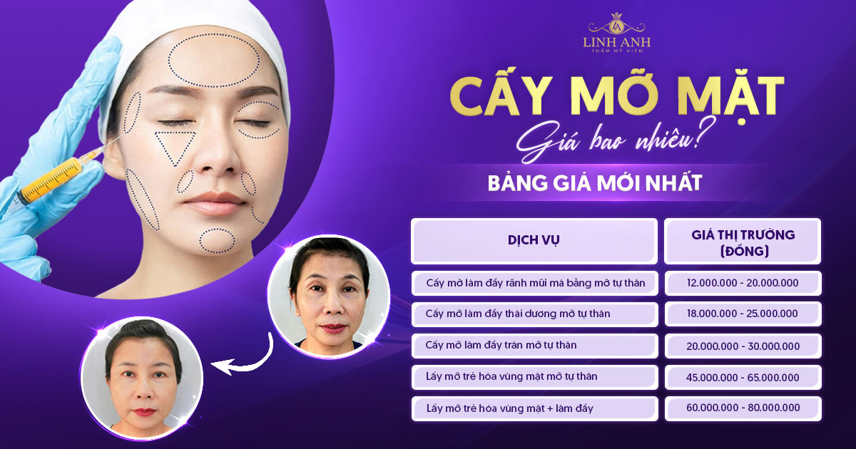 cấy mỡ mặt giá bao nhiêu