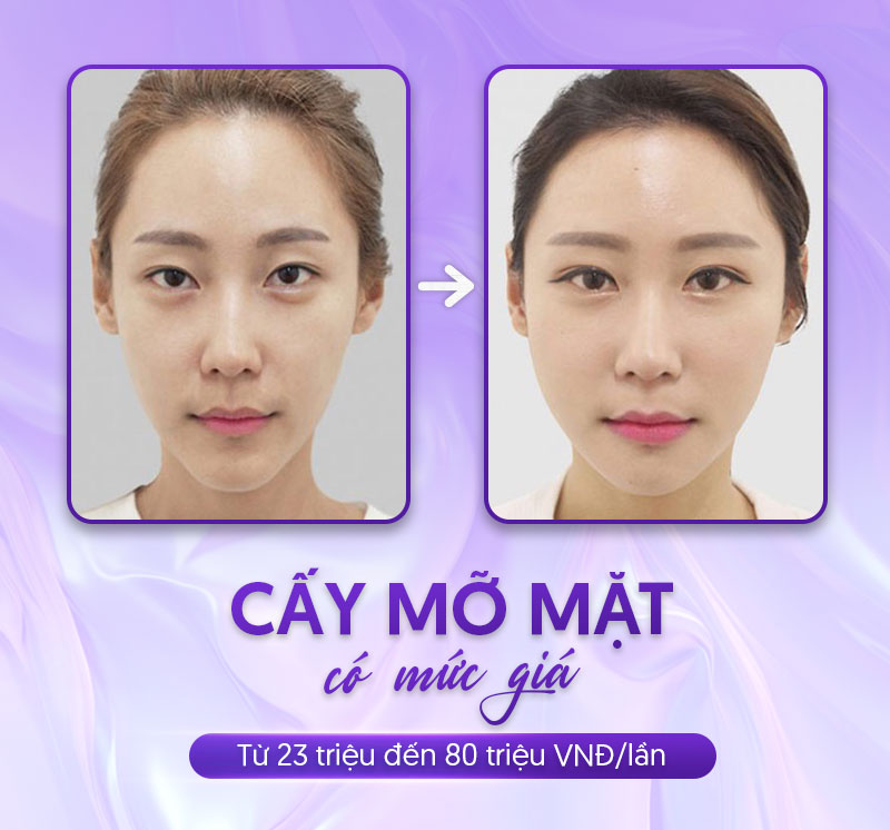 cấy mỡ tự thân lên mặt giá bao nhiêu cấy mỡ tự thân lên mặt giá bao nhiêu