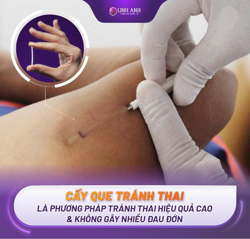 cấy que tránh thai có bị nám da không cấy que tránh thai có bị nám da hay sạm da không