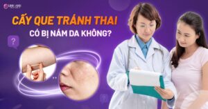 cấy que tránh thai có bị nám da không