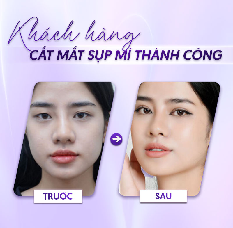 chi phí chữa sụp mí mắt chi phí chữa sụp mí mắt