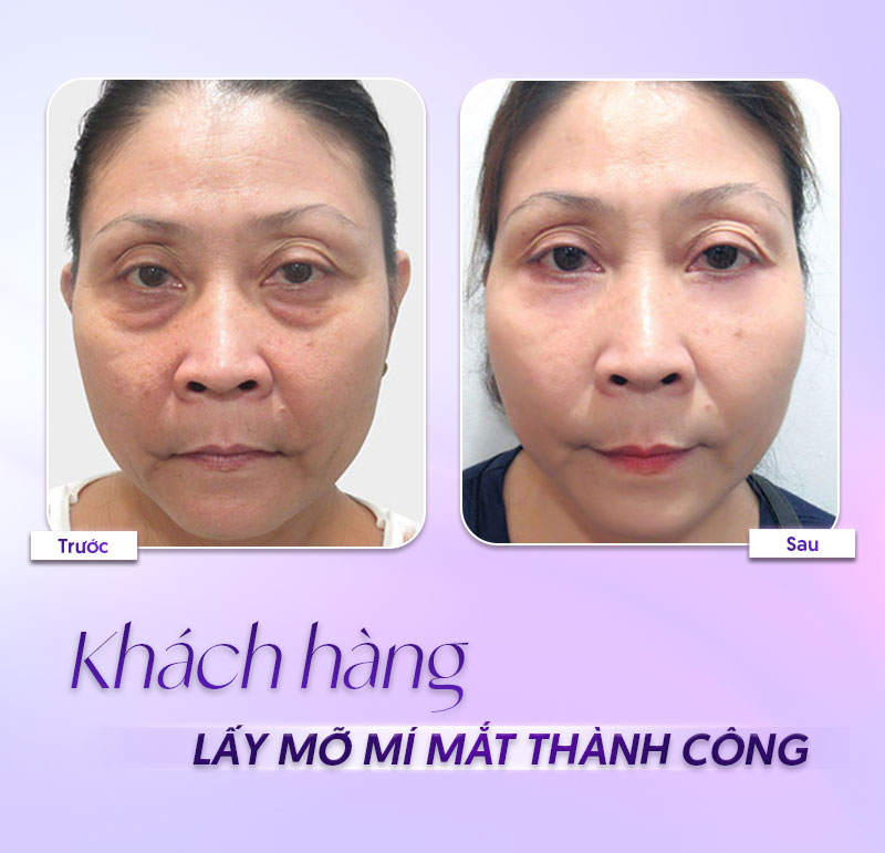 chi phí lấy mỡ bọng mắt trên chi phí lấy mỡ bọng mắt trên