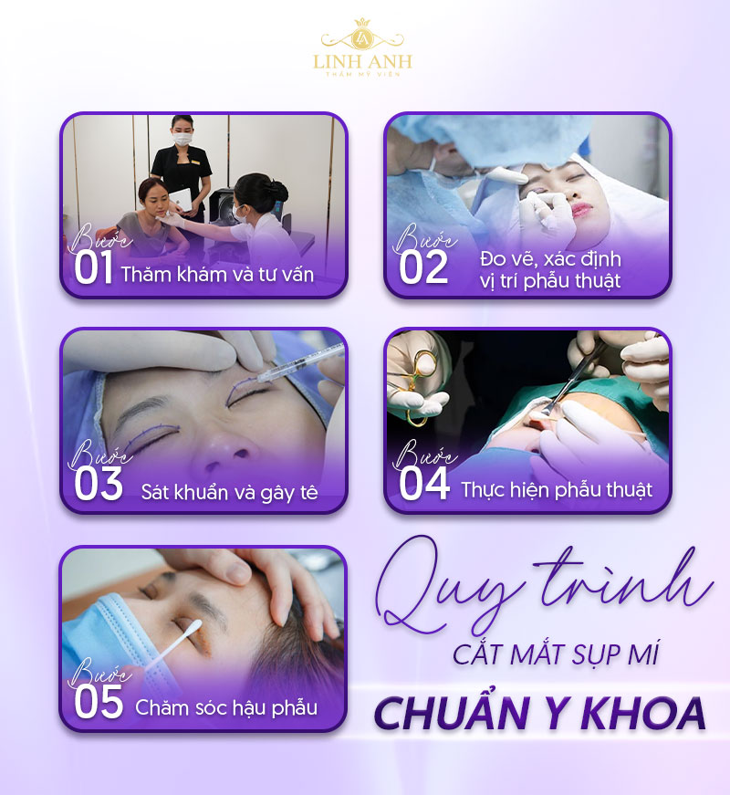 chi phí phẫu thuật sụp mí mắt bẩm sinh chi phí phẫu thuật sụp mí mắt bẩm sinh