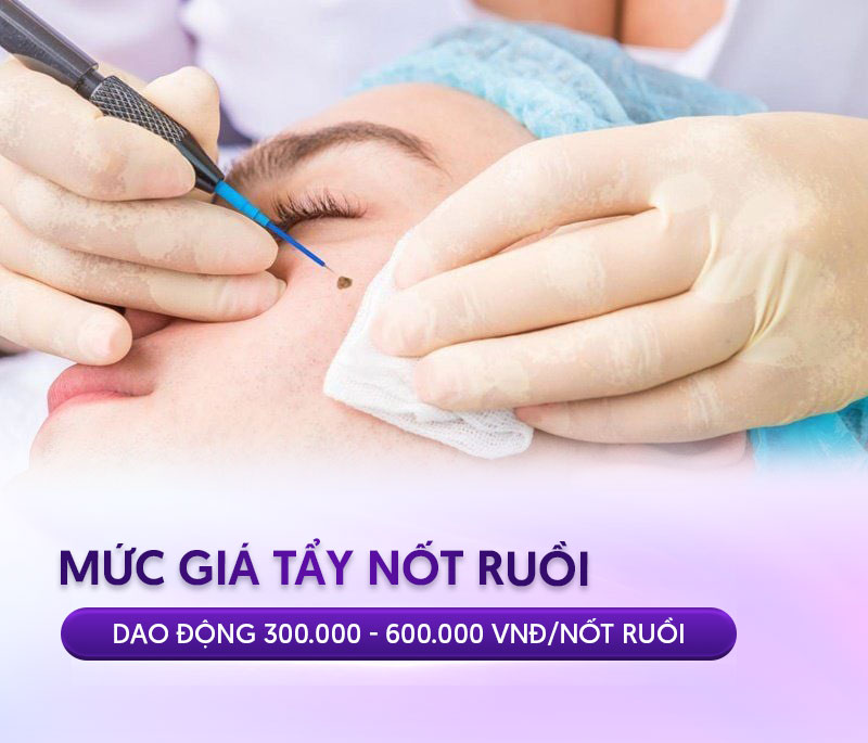 chi phí tẩy nốt ruồi chi phí tẩy nốt ruồi