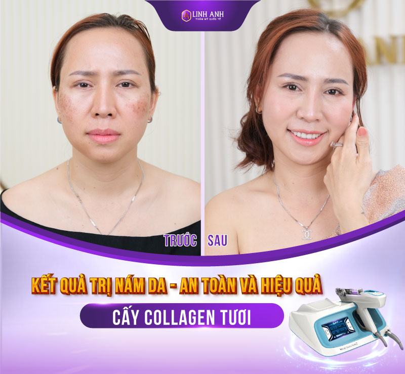 cách trị nám bằng rau diếp cá chữa thâm nám bằng rau diếp cá