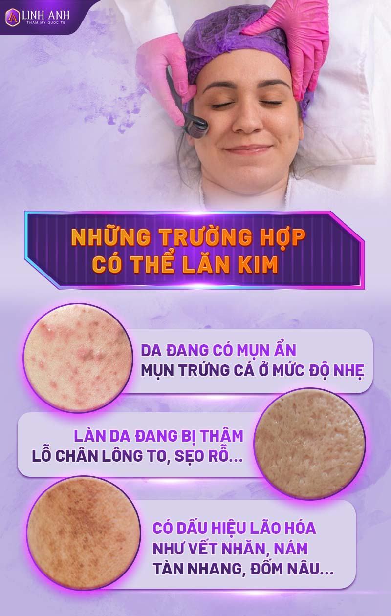 lăn kim trị mụn có tốt không - Thẩm mỹ Quốc tế Linh Anh có nên lăn kim trị mụn không