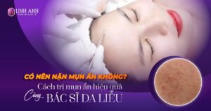 có nên nặn mụn ẩn không