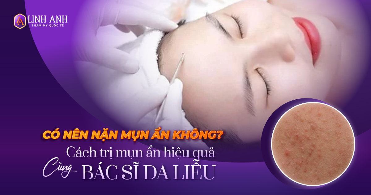 có nên nặn mụn ẩn không