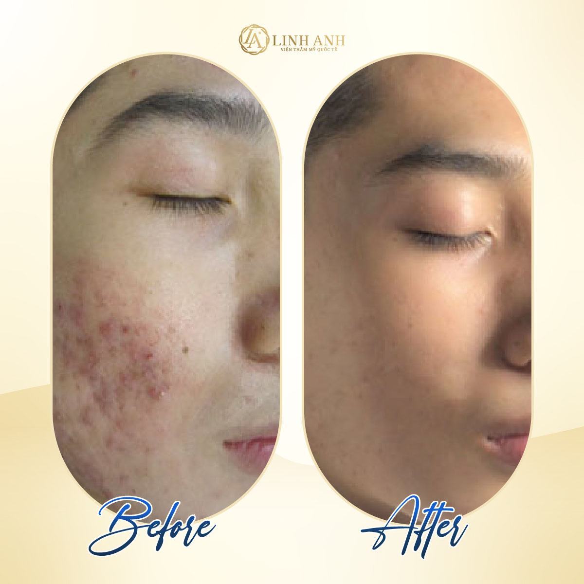 kem đánh răng trị mụn đầu đen có nên trị mụn đầu đen bằng kem đánh răng - Viện thẩm mỹ quốc tế Linh Anh