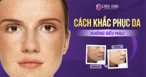 da không đều màu