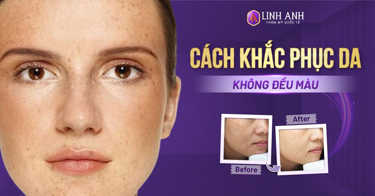 da không đều màu