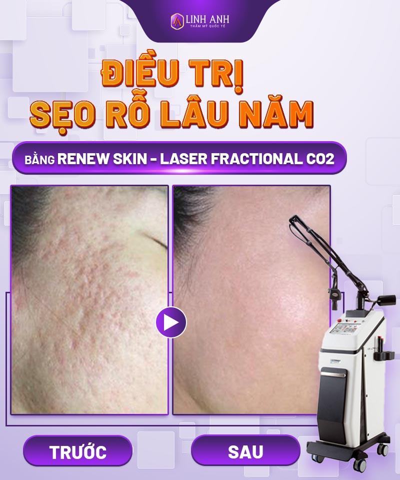 trị sẹo rỗ lâu năm - Thẩm mỹ Quốc tế Linh Anh địa chỉ điều trị sẹo rỗ lâu năm