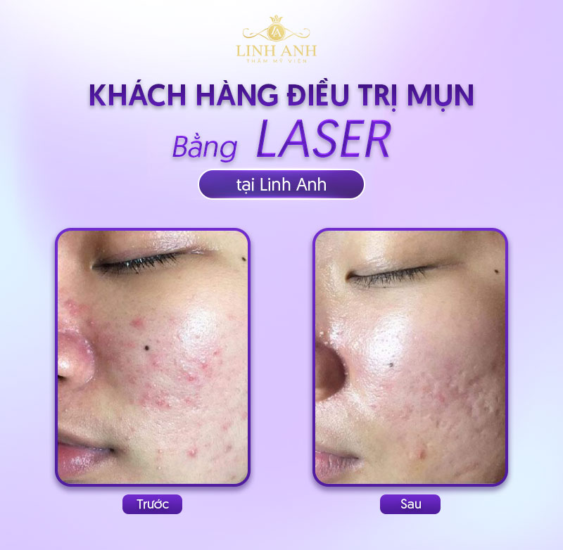 điều trị mụn bằng laser bao nhiêu tiền điều trị mụn bằng laser bao nhiêu tiền