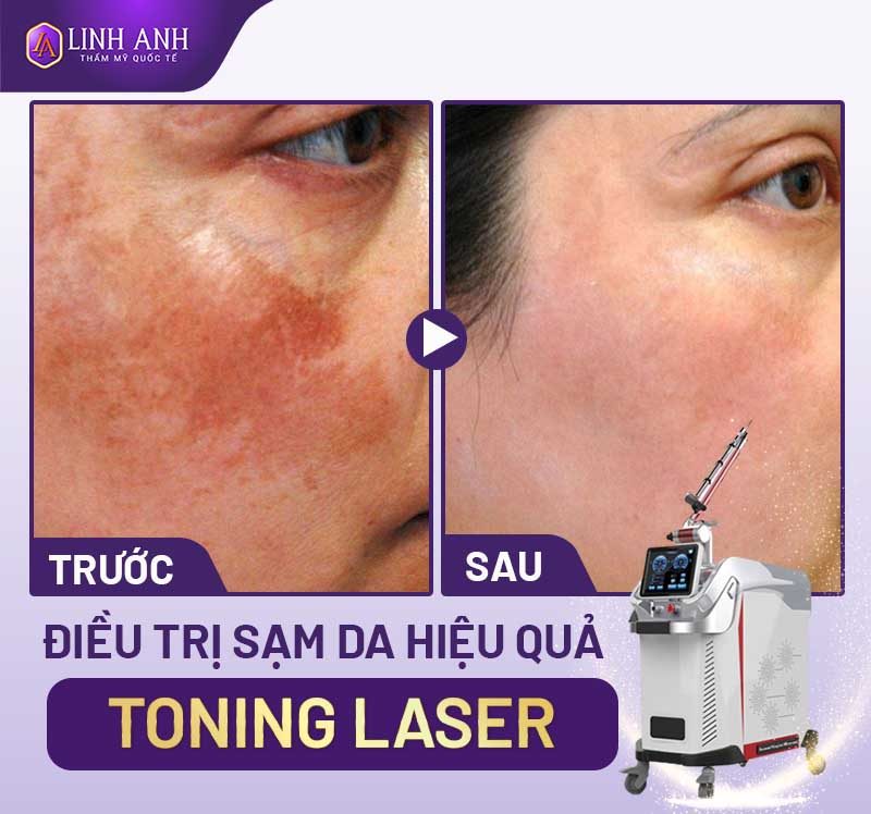 cách trị sạm da mặt đơn giản điều trị sạm da