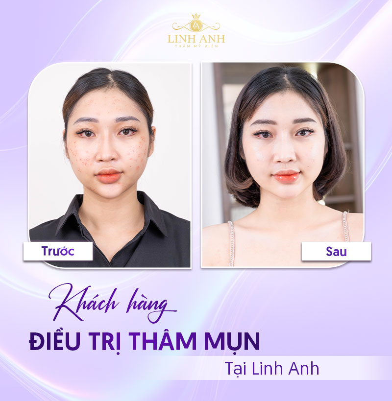 điều trị thâm mụn tại spa điều trị thâm mụn tại spa