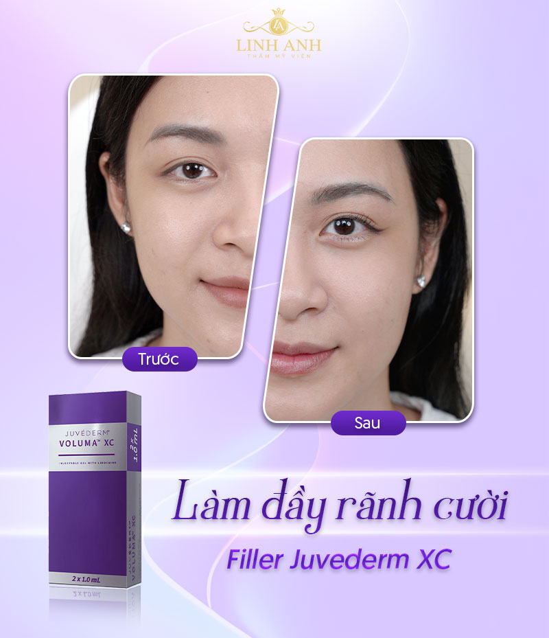 filler Juvederm bao nhiêu tiền 1cc filler Juvederm bao nhiêu tiền 1cc