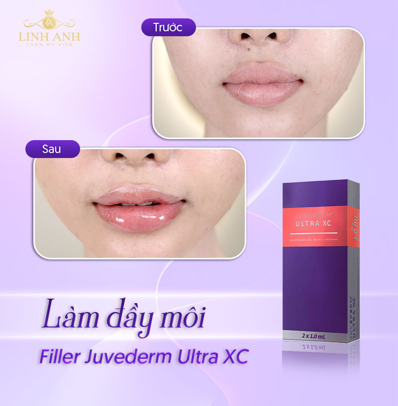 filler Juvederm pháp giá bao nhiêu filler Juvederm pháp giá bao nhiêu