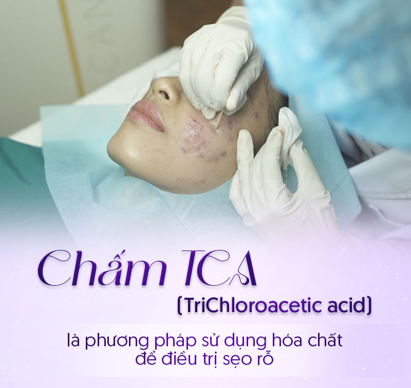 giá chấm tca giá chấm tca