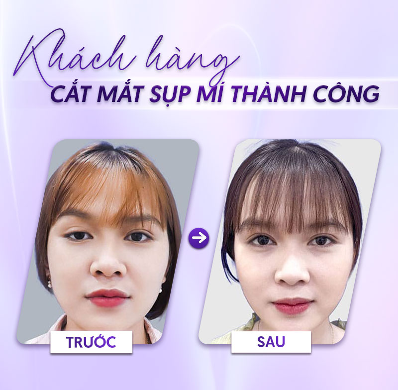 giá chữa sụp mí giá chữa sụp mí